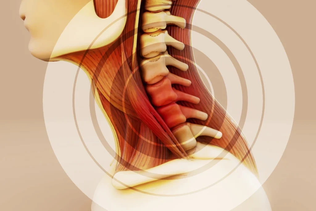 Upravljanje problemima vratne kralježnice povezanim sa stresom